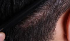 Before Hair Transplant&nbsp;Front